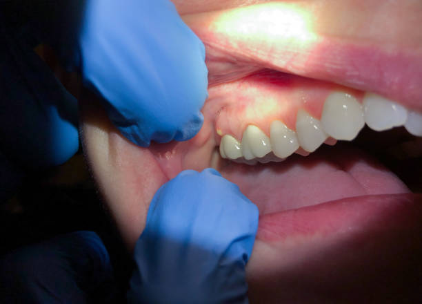 Best Emergency Root Canal Treatment in Christiansburg, VA