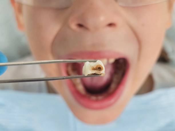 Best Emergency Dentist for Lost Fillings or Crowns in Christiansburg, VA